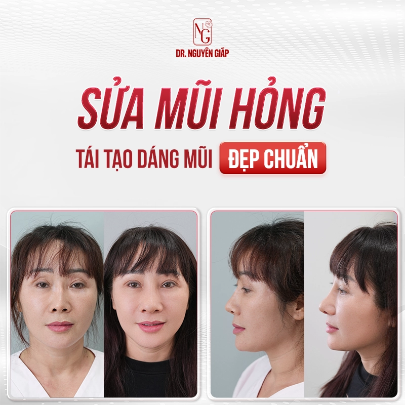 sửa biến chứng nâng mũi 2 Sửa biến chứng mũi 20 năm và kết quả ấn tượng