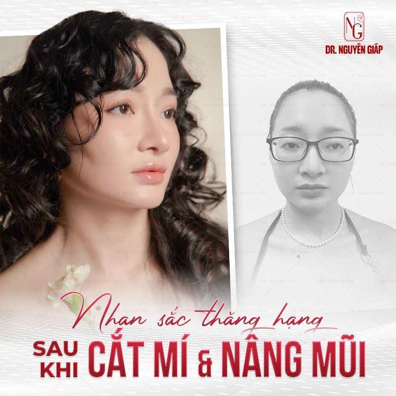 khach-hang-cat-mi-nang-mui Nhan sắc rạng rỡ, xinh đẹp sau nâng mũi và cắt mí tại Dr. Nguyên Giáp
